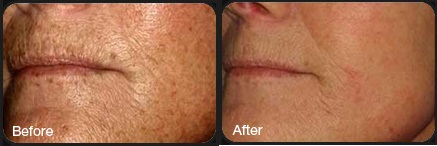ipl-skin41
